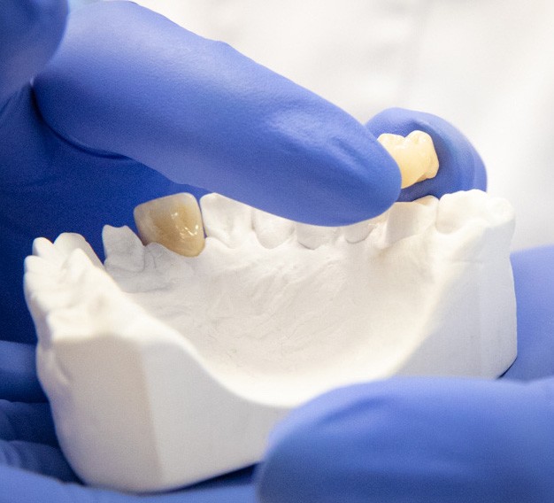 Kodėl specialistai rekomenduoja rinktis dantų protezavimą