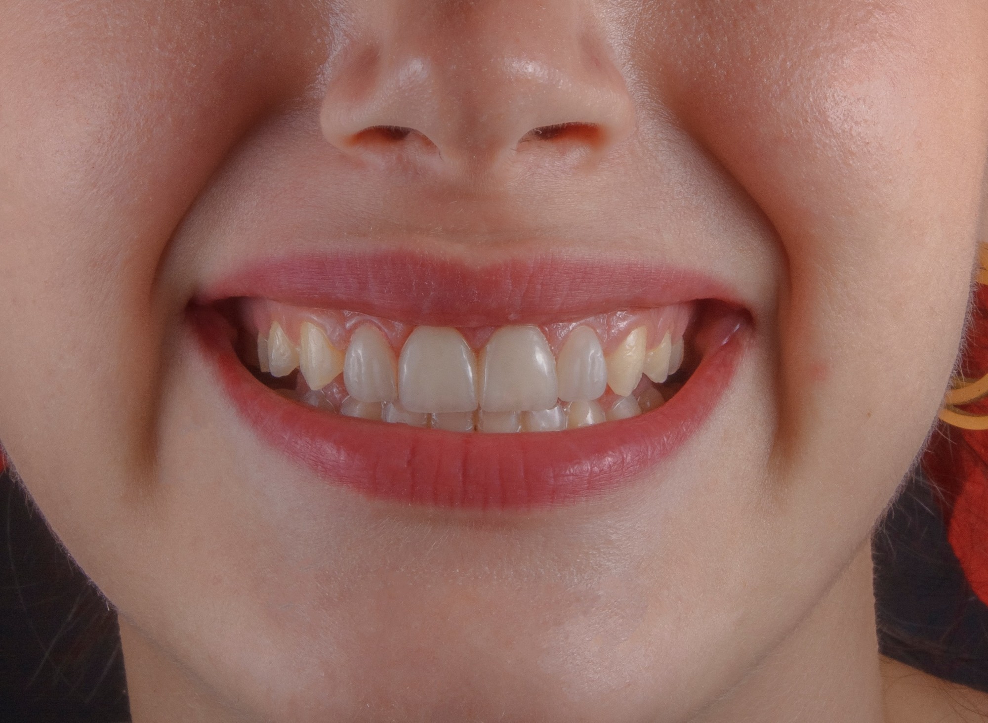 Dantų implantai – ką verta žinoti?