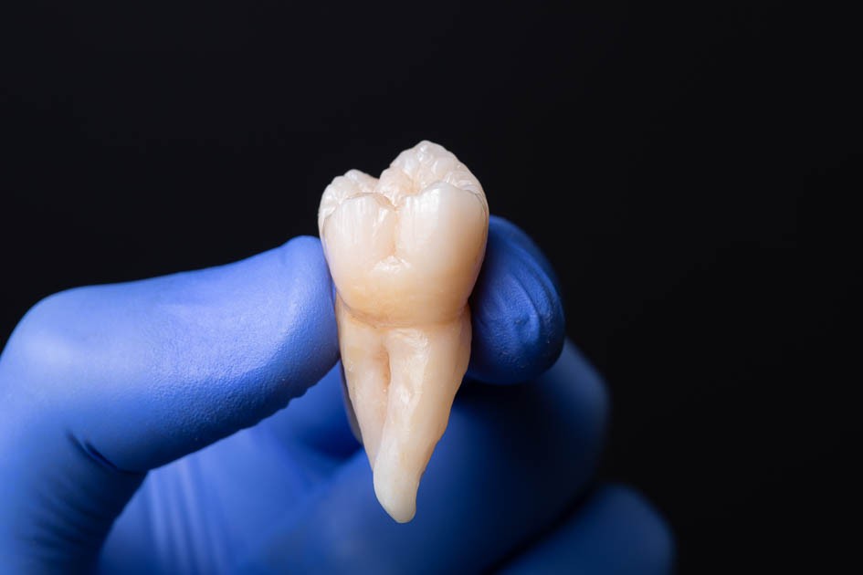 Dantų implantai – galimybė džiaugtis sveikais dantimis