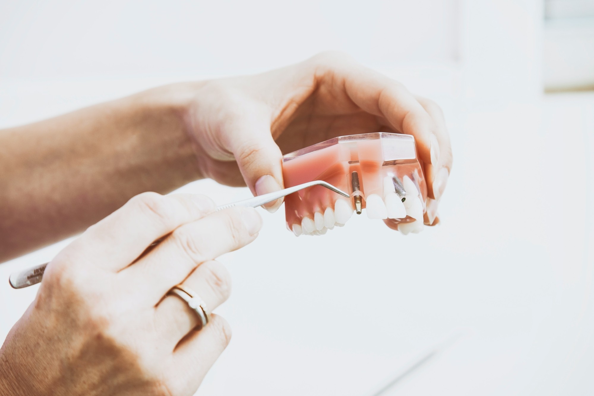 Dantų protezavimas: išimami ir fiksuoti dantų protezų tipai