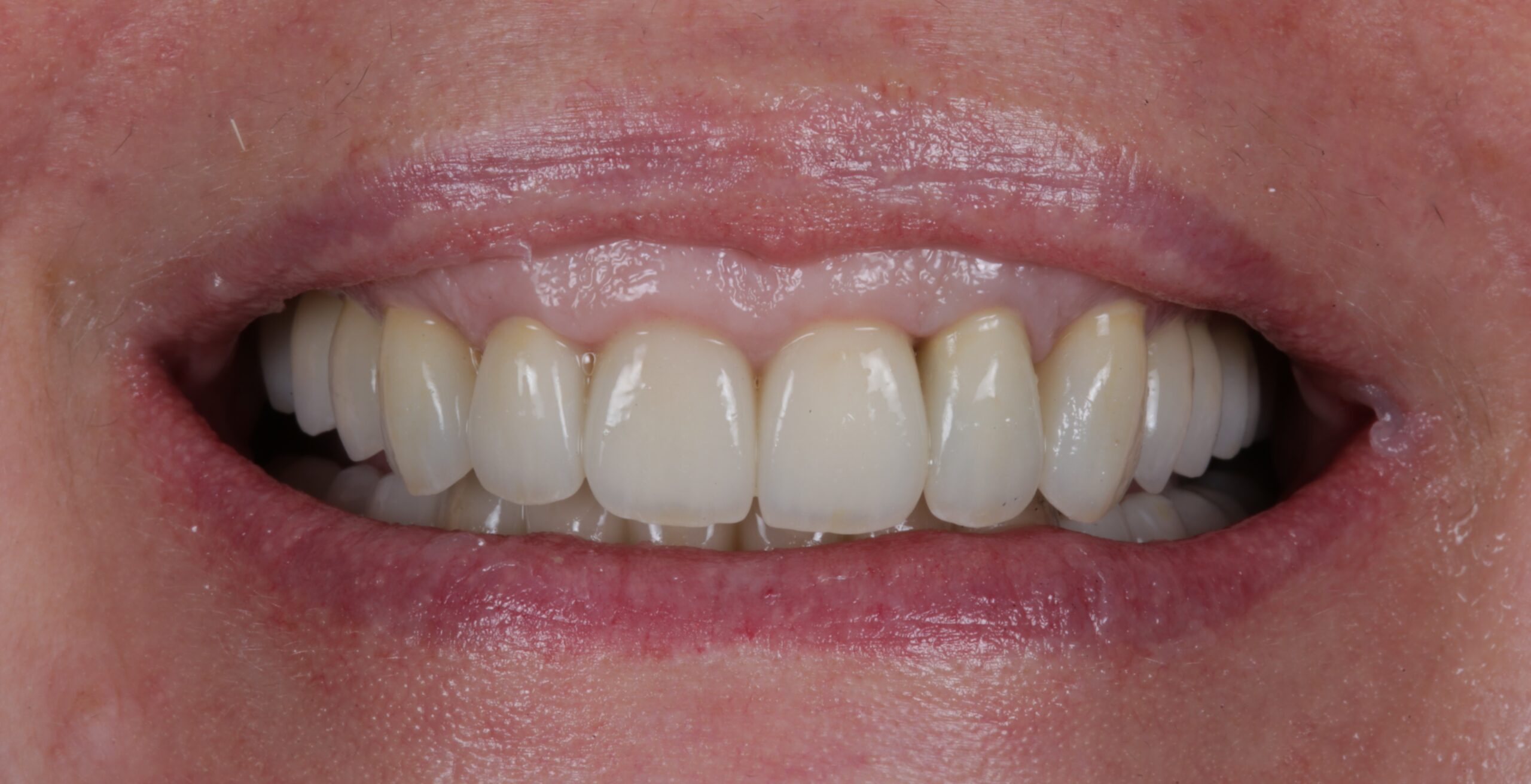 Po periodontito gydymo sypsenos linijos korekcijosprotezavimo scaled